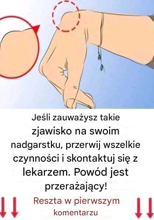 Jeśli zauważyłeś u siebie taki guzek na nadgarstku, może to być powód do zmartwień.